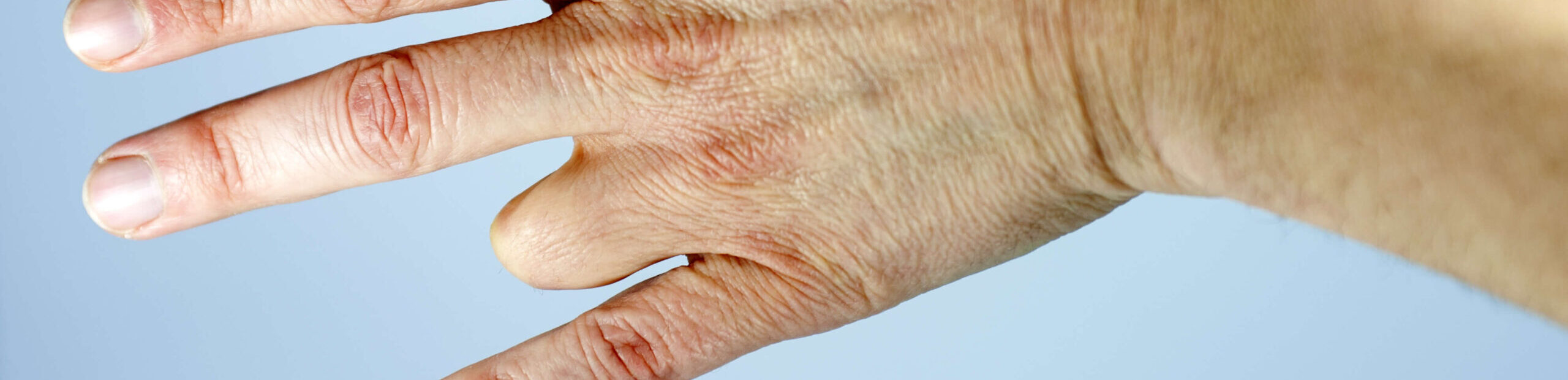 Finger Amputation Surgery Dallas Hand Surgeons Dr. AzouzAzouz Hand