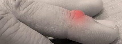 Mucous cyst is a benign growth that appears at the top of the finger, below the fingernail, and above the top joint