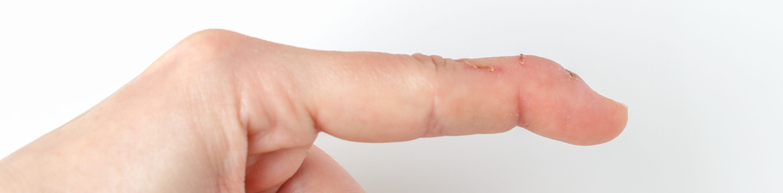 Mallet Finger Surgery Dallas Hand Surgeon Dr. AzouzAzouz Hand Surgery