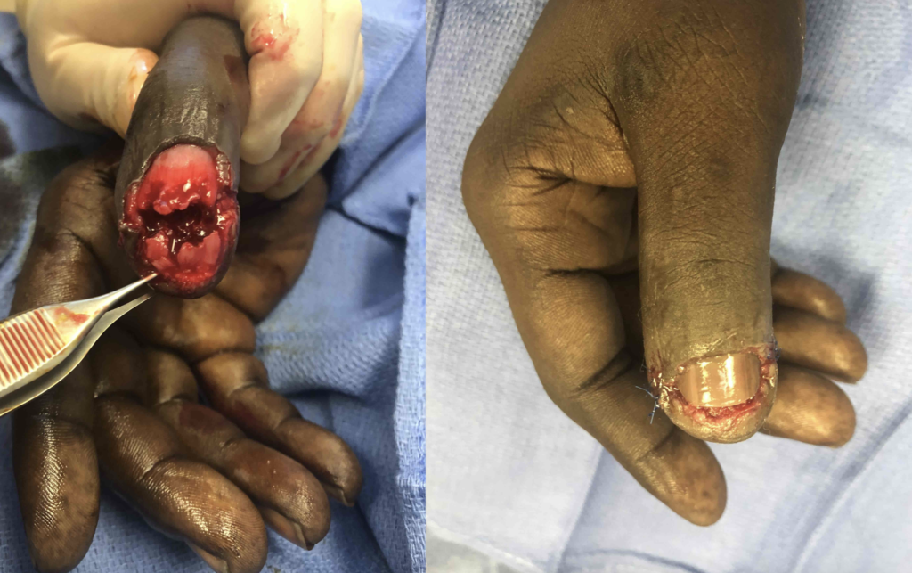 before and after fingertip amputation