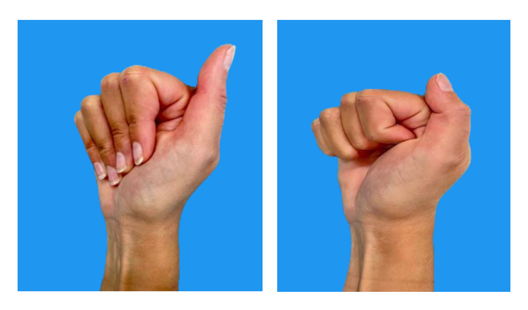 Fist exercise for hand surgery